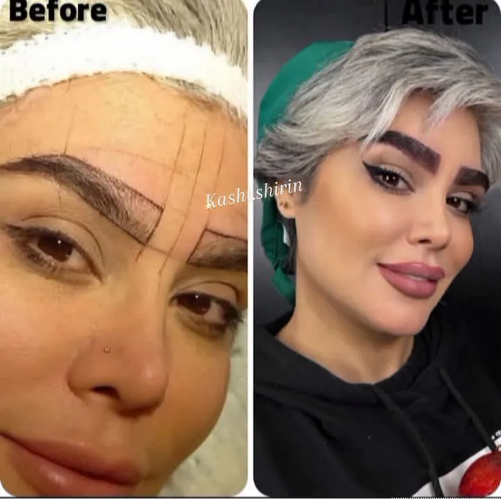 کاشت ابرو شیرین